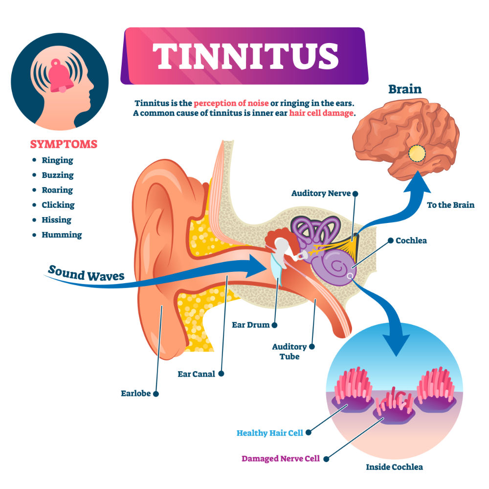 How does tinnitus work?